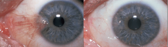 Before & After Pterygium Removal