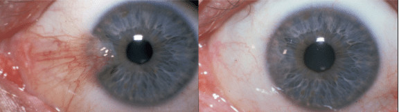 Screen Shot 2019-06-12 at 2.05.54 PM Before & After Pterygium Removal